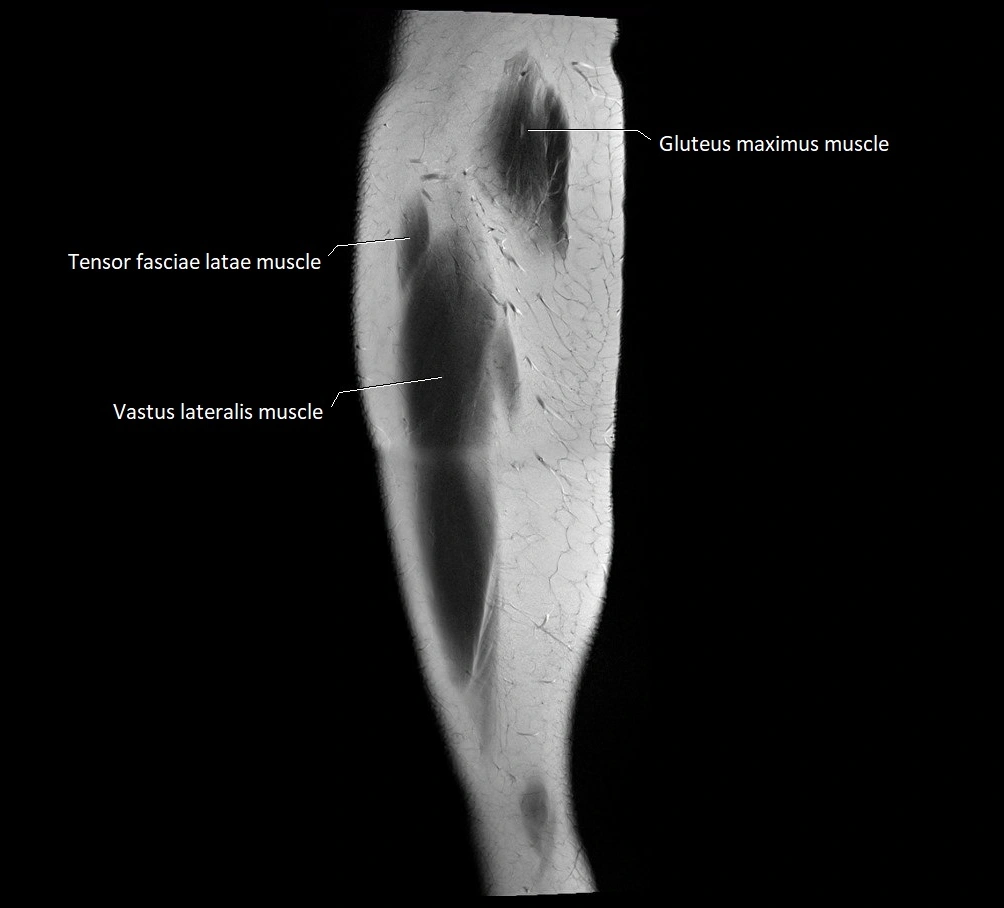 Thigh sagittal cross sectional anatomy MRI 3T image 2.webp